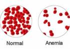 Anemia: una consulta frecuente