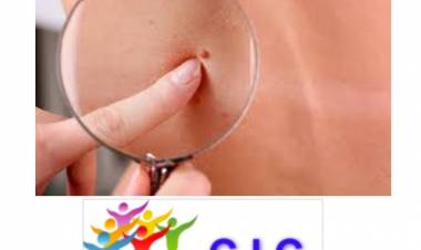 Cáncer de piel:  Se puede y debe prevenir