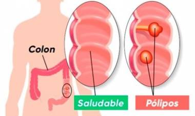 Cáncer de Colon: la prevención es fundamental