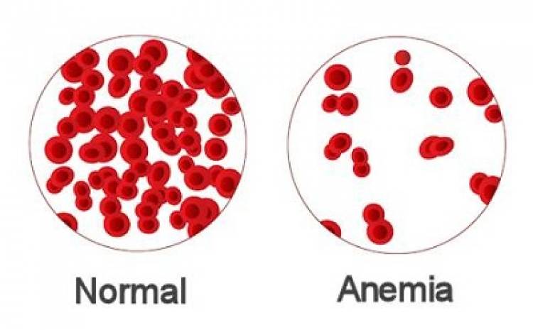 Anemia: una consulta frecuente